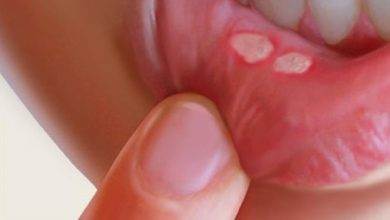 Aft nedir nasıl tedavi edilir