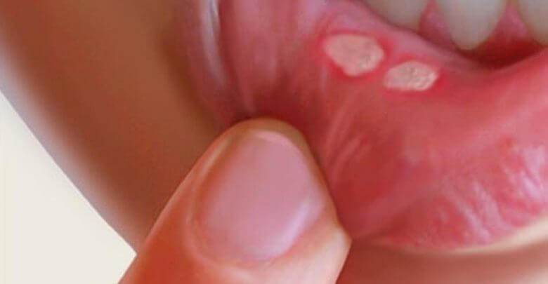 Aft nedir nasıl tedavi edilir