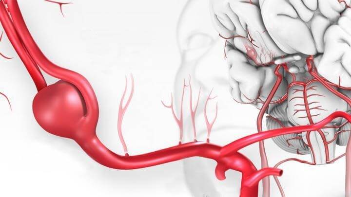 Beyin kanaması nedir