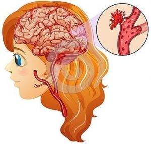 Beyin Kanaması Belirtileri Nelerdir ?