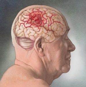 Beyin tümörü Nedir ?