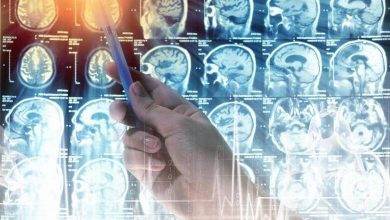 Beyin Tümörü Sebepleri Nelerdir ?