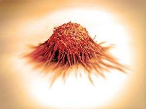 Beyin Tümörü Evreleri Nelerdir ?