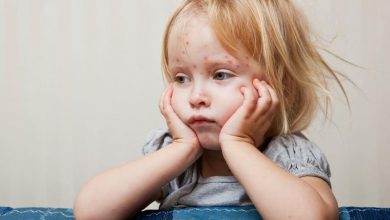 Çocuklarda Suçiçeği nedir ?