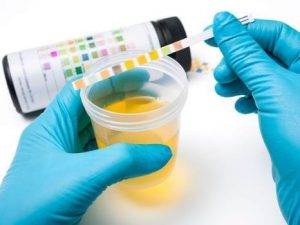 İdrar tahlili nedir ? Neden yapılır ?