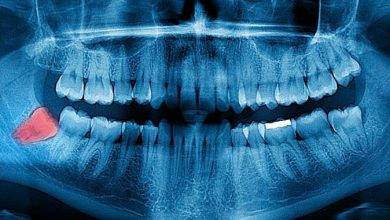 Çene Darlığı Nedir