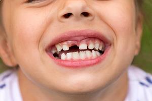 Çene Darlığı Tedavi Edilmezse Ne Olur