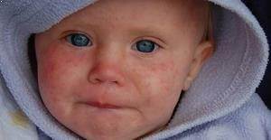 Kızamık hastalığı nasıl ve neden oluşur?