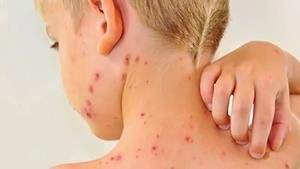 Kızamık hastalığı'nın belirtileri nelerdir