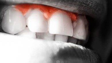 Diş Eti Çekilmesi Nedir