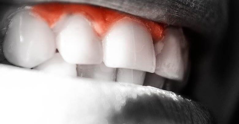 Diş Eti Çekilmesi Nedir