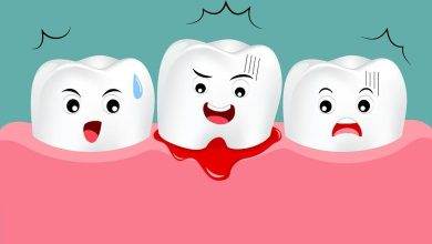 Diş Eti Kanaması Nedir