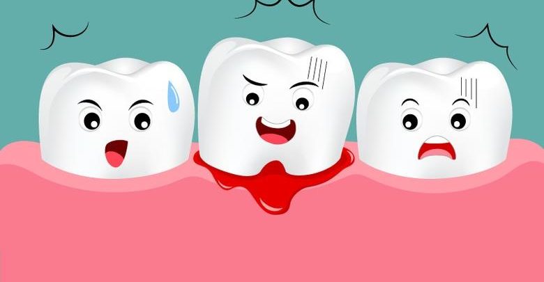 Diş Eti Kanaması Nedir