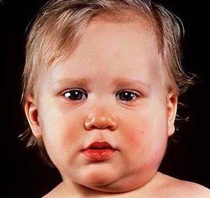 Kabakulak Hastalığı nedir