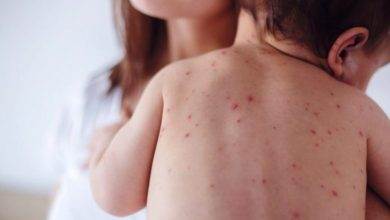 Kızamıkçık Hastalığı Nedir