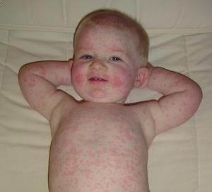 Kızamıkçık Hastalığının Belirtileri Nelerdir