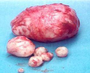 Miyom tedavisi nasıl yapılmaktadır