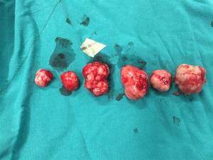 Miyom Tedavisi İçin Miyomektomi Nasıl Yapılır