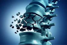 Osteoporoz Nedir