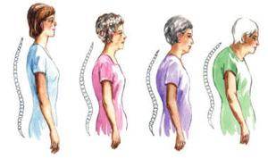 Osteoporoz Belirtileri Nelerdir