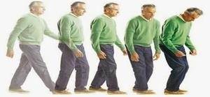 Parkinson Hastalığı Nasıl İlerler?