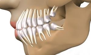 Gömülü 20’lik Diş Nedir