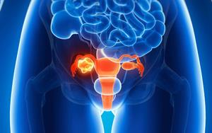 Yumurtalık Kanseri teşhisi nasıl konur