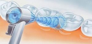 Diş eti iltihabı nasıl önlenebilir