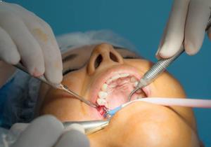 Diş eti kanaması nasıl tedavi edilir