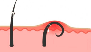 Kıl Dönmesi Ameliyatı Yöntemleri