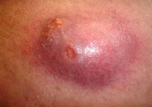 Kıl Dönmesi Belirtileri Nelerdir