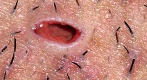 Kıl Dönmesi Tedavisi