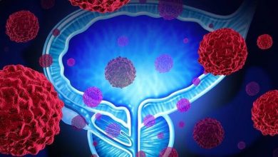 Prostat Kanseri Nedir