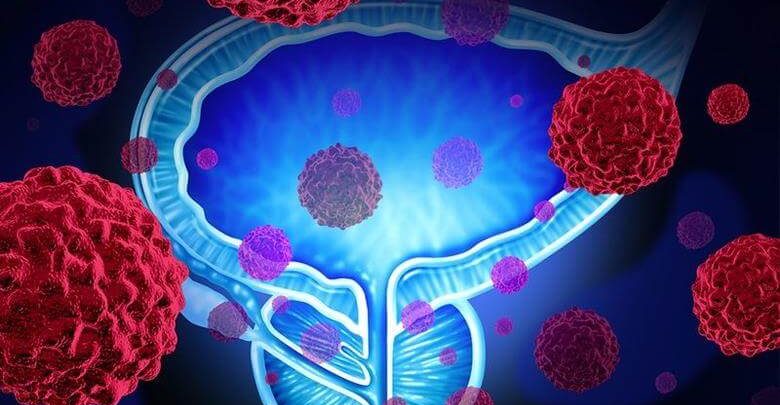 Prostat Kanseri Nedir