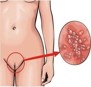 Genital herpes nasıl teşhis edilir