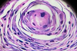 Genital Siğil Nasıl Olur