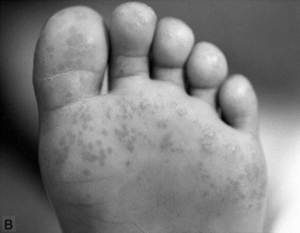 Reiter Sendromu (Reaktif Artrit) Belirtileri Nelerdir