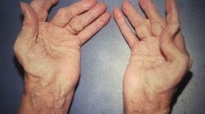 Reiter Sendromu (Reaktif Artrit) Nasıl Teşhis Edilir