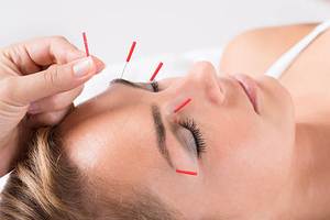 Gerilim tipi baş ağrısı tedavisi - Akupunktur