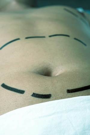 Mide küçültme ameliyatı nasıl yapılır