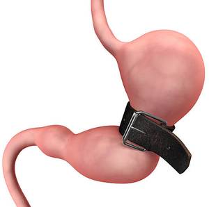 Mide küçültme ameliyatına dair bilmeniz gerekenler