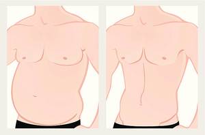 Mide küçültme ameliyatının faydaları