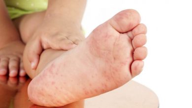 El Ayak Hastalığı Nedir