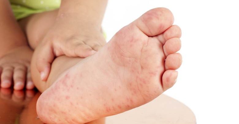 El Ayak Hastalığı Nedir