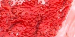 adet kanamasının çok olması