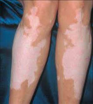 addison hastalığı neden olur