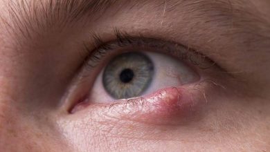 arpacık neden çıkar