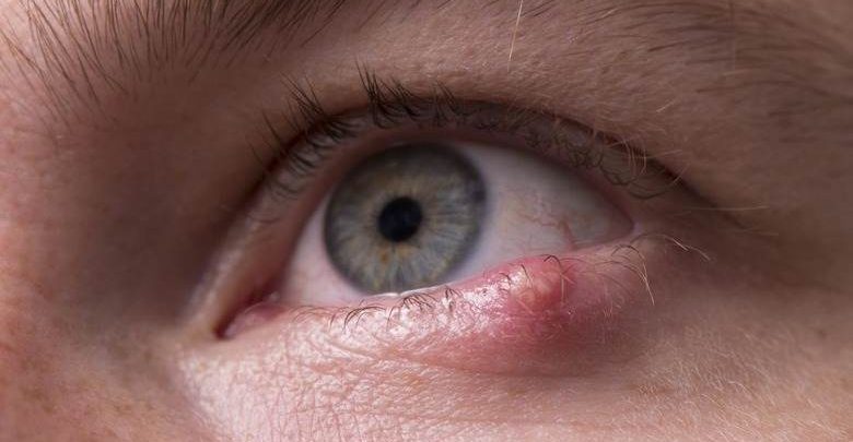 arpacık neden çıkar