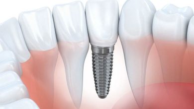 implant nasıl yapılır