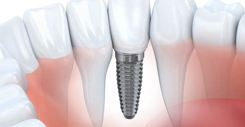 implant nasıl yapılır